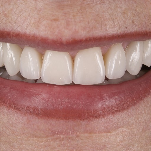 Combined treatment with DSD